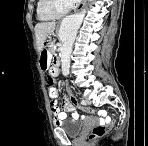 File:Aortic aneurysm and Lemmel syndrome (Radiopaedia 86499-102554 D 51).jpg