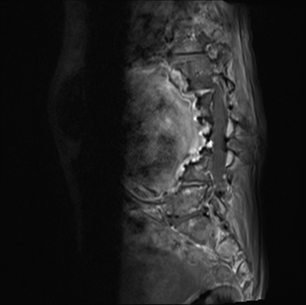 File:Aortic aneurysm with spinal destruction (Radiopaedia 42301-45409 Sagittal T1 fat sat 28).jpg