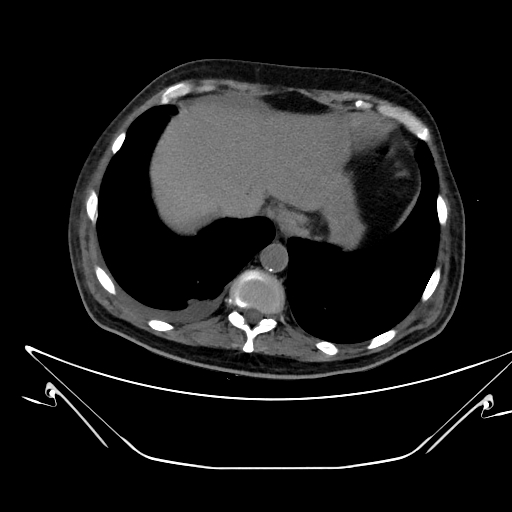 Aortic arch aneurysm (Radiopaedia 84109-99365 Axial non-contrast 239).jpg