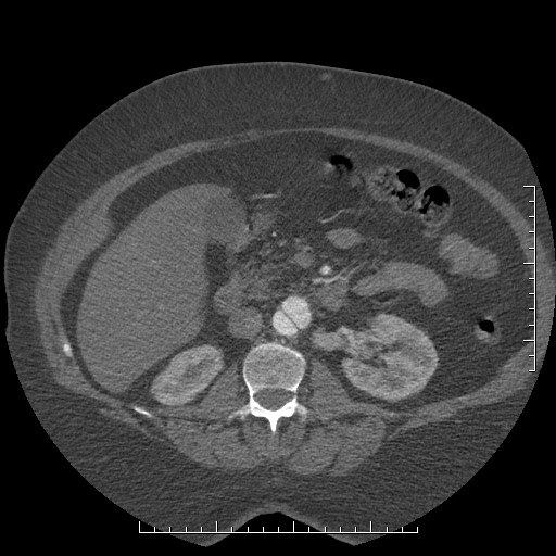File:Aortic dissection- Stanford A (Radiopaedia 35729-37268 B 68).jpg