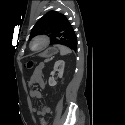 File:Aortic dissection- Stanford A (Radiopaedia 37759-39664 Sagittal C+ delayed 36).png