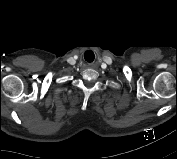 Aortic dissection (CTPA) (Radiopaedia 75506-86750 A 1).jpg