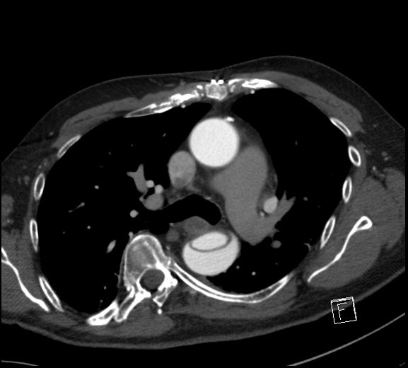 File:Aortic dissection (CTPA) (Radiopaedia 75506-86750 A 39).jpg