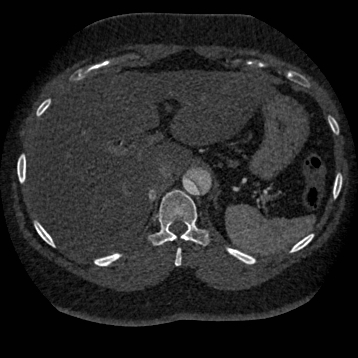 Aortic dissection (Radiopaedia 57969-64959 A 304).jpg