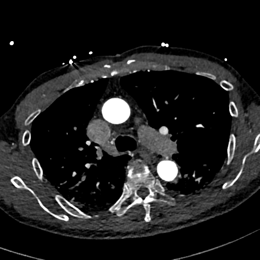 Aortic dissection - DeBakey type II (Radiopaedia 64302-73082 A 33).png