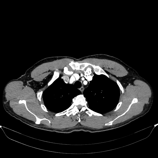 Aortic dissection - Stanford type A (Radiopaedia 83418-98500 A 13).jpg