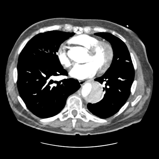 Aortic dissection - Stanford type B (Radiopaedia 50171-55512 B 1).png