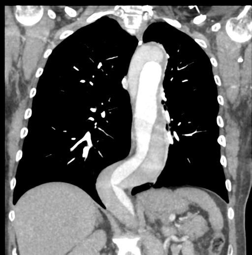 File:Aortic dissection - Stanford type B (Radiopaedia 50171-55512 B 52).png