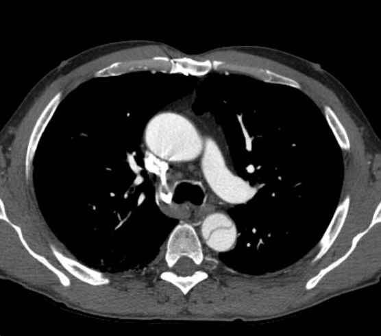 Aortic dissection - Stanford type B (Radiopaedia 73648-84437 A 35).jpg