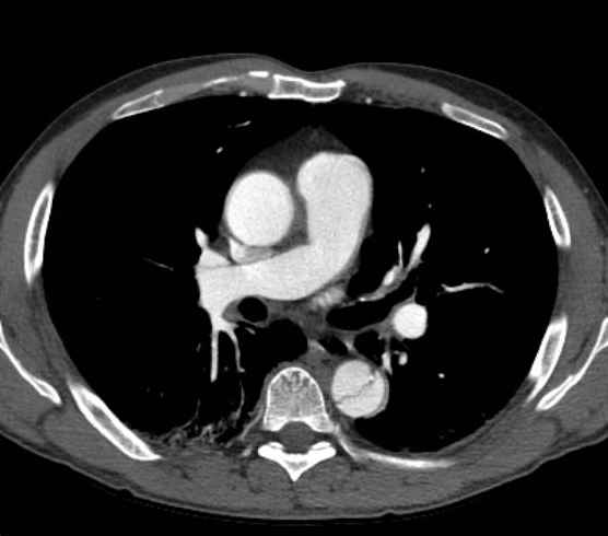 Aortic dissection - Stanford type B (Radiopaedia 73648-84437 A 48).jpg