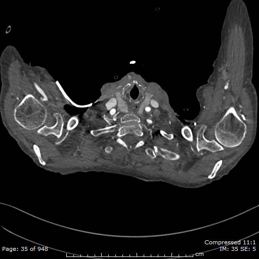 File:Aortic dissection with extension into aortic arch branches (Radiopaedia 64402-73204 B 35).jpg