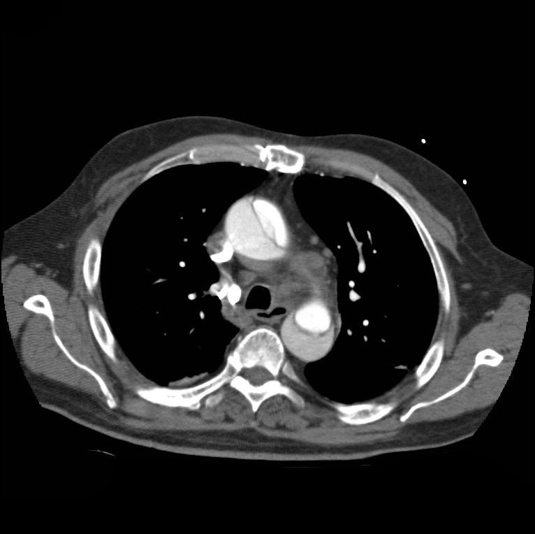 Aortic dissection with rupture into pericardium (Radiopaedia 12384-12647 A 20).jpg
