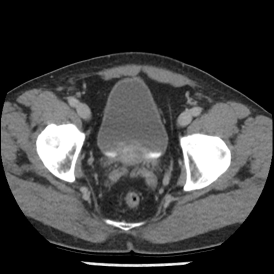 Aortic intramural hematoma (type B) (Radiopaedia 79323-92387 Axial C+ delayed 107).jpg
