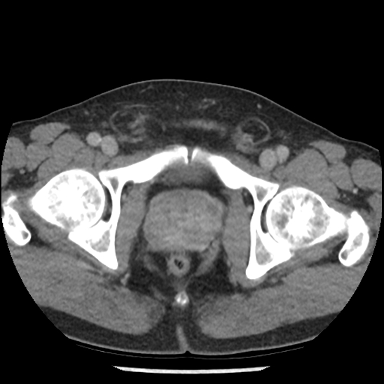 Aortic intramural hematoma (type B) (Radiopaedia 79323-92387 Axial C+ delayed 113).jpg