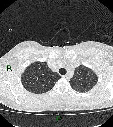 File:Aortic valve endocarditis (Radiopaedia 87209-103485 Axial lung window 22).jpg