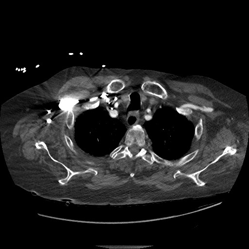 Aortoesophageal fistula with endovascular repair (Radiopaedia 73781-84592 Axial C+ CTPA 7).jpg