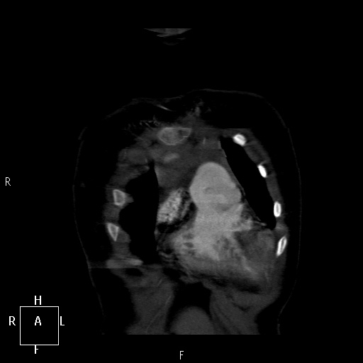 File:Aortopulmonary septal defect (Radiopaedia 41990-45013 Coronal C+ CTPA 2).jpg