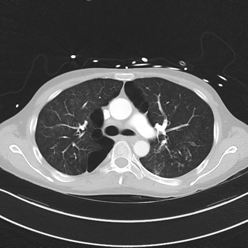 Apical bullous disease in a heavy smoker (Radiopaedia 33067-34092 Axial lung window 25).png