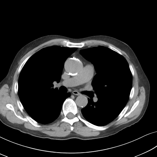File:Apical pulmonary metastasis (Radiopaedia 46338-50754 B 31).png