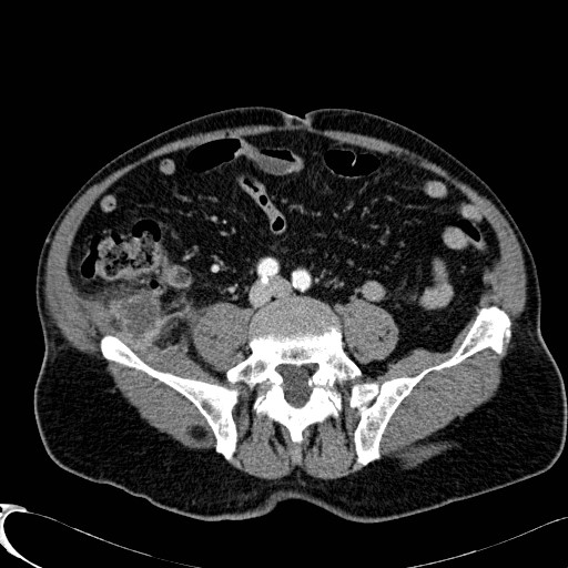 Appendiceal adenocarcinoma complicated by retroperitoneal abscess (Radiopaedia 58007-65039 B 91).jpg