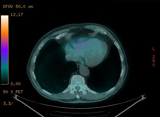 Appendiceal adenocarcinoma complicated by retroperitoneal abscess (Radiopaedia 58007-65041 Axial PET-CT 95).jpg