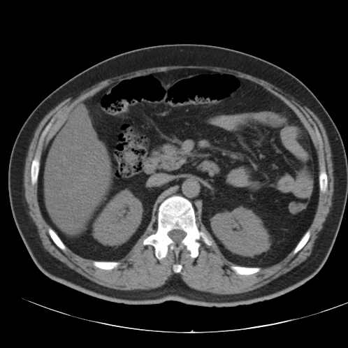 Appendicitis and giant appendicolith (Radiopaedia 80251-93588 Axial non-contrast 18).jpg