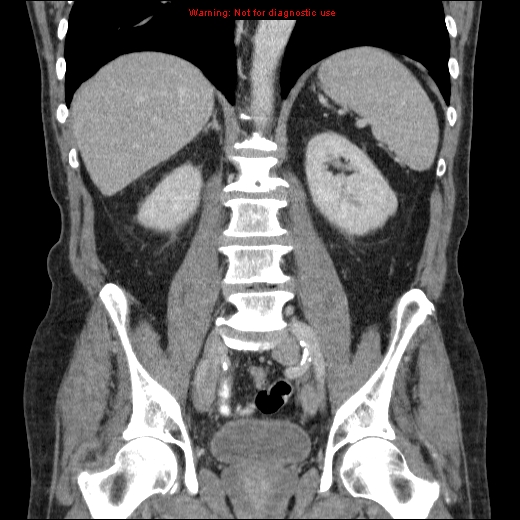 File:Appendicitis mass in inguinal hernia (Radiopaedia 26858-27029 B 48).jpg