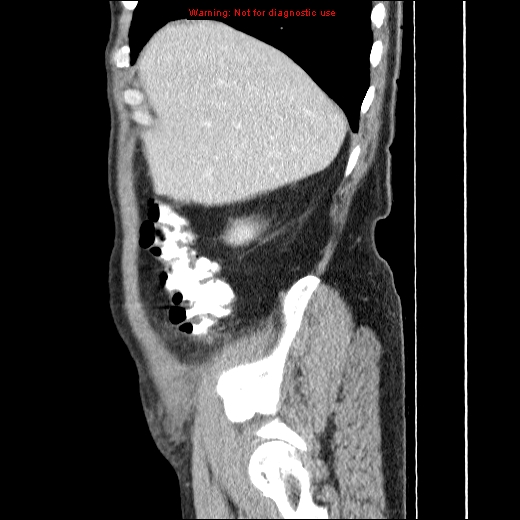 File:Appendicitis mass in inguinal hernia (Radiopaedia 26858-27029 C 7).jpg