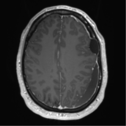 Arachnoid cyst with subdural hematoma (Radiopaedia 85892-101743 Axial T1 C+ 59).png