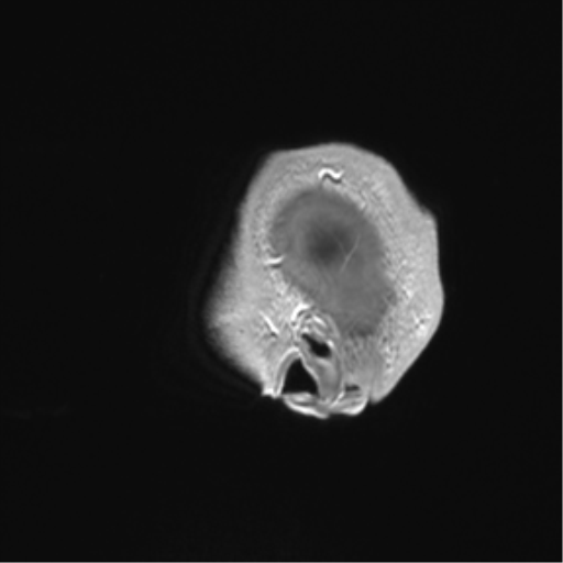 Arachnoid cyst with subdural hematoma (Radiopaedia 85892-101743 Sagittal T1 C+ 89).png