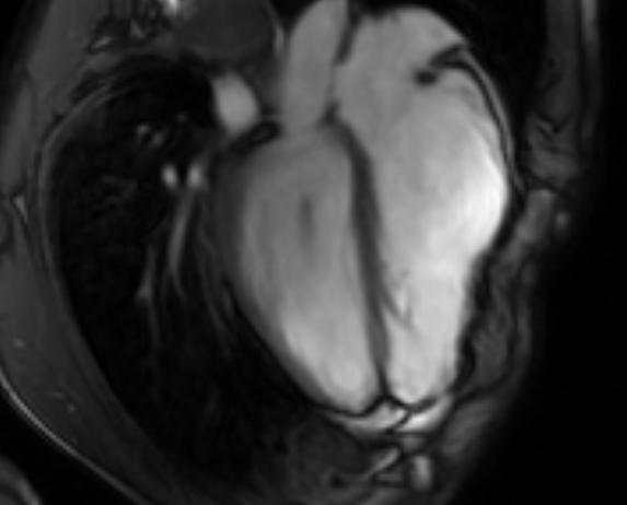 File:Arrhythmogenic right ventricular cardiomyopathy (Radiopaedia 69564-79464 4ch cine 100).jpg