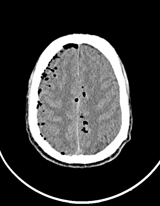 Arrow injury to the brain (Radiopaedia 72101-82607 Axial non-contrast 83).jpg