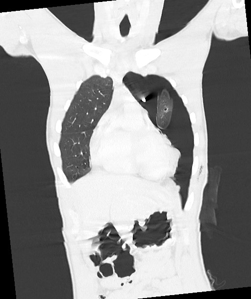 Arrow injury to the chest (Radiopaedia 85367-100975 Coronal lung window 53).jpg