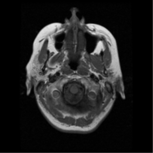 File:Arteriovenous malformation (cerebral) (Radiopaedia 40070-42580 Axial T1 1).png