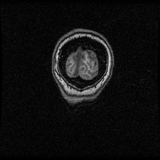 Arteriovenous malformation (cerebral) (Radiopaedia 40070-42580 Coronal T1 3).png