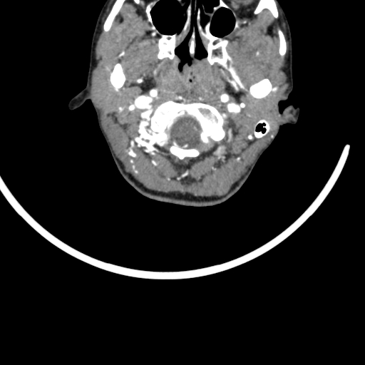Arteriovenous malformation of the neck (Radiopaedia 53935-60062 A 63).jpg