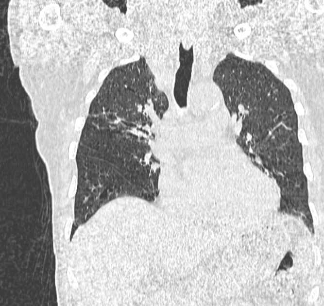 Aspergilloma (Radiopaedia 44592-48327 Coronal lung window 55).jpg