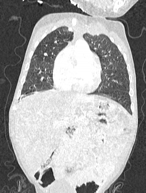 Asplenia syndrome (Radiopaedia 73083-83792 Coronal lung window 43).jpg