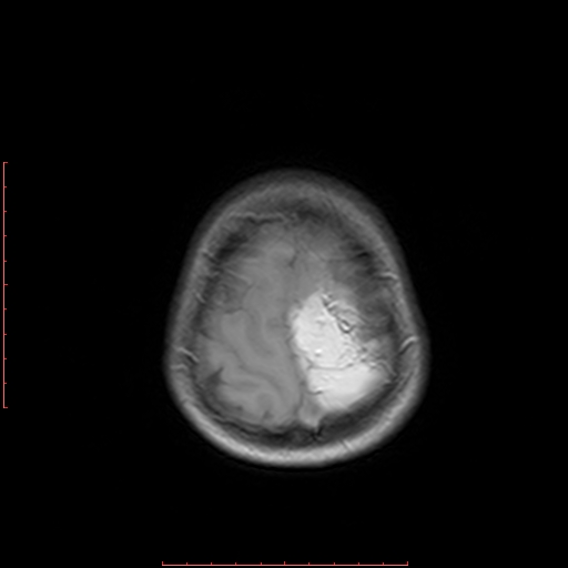 File:Astroblastoma (Radiopaedia 74287-85162 Axial T1 21).jpg