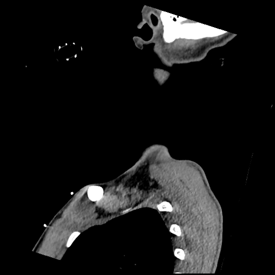 File:Atlanto-occipital dissociation (Traynelis type 1), C2 teardrop fracture, C6-7 facet joint dislocation (Radiopaedia 87655-104061 D 78).jpg