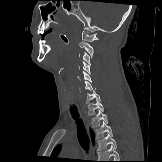 File:Atlanto-occipital dissociation (Traynelis type 1), C2 teardrop fracture, C6-7 facet joint dislocation (Radiopaedia 87655-104061 Sagittal bone window 29).jpg