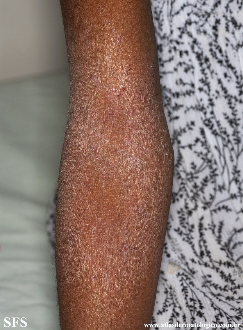 Atopic Dermatitis (Dermatology Atlas 37).jpg