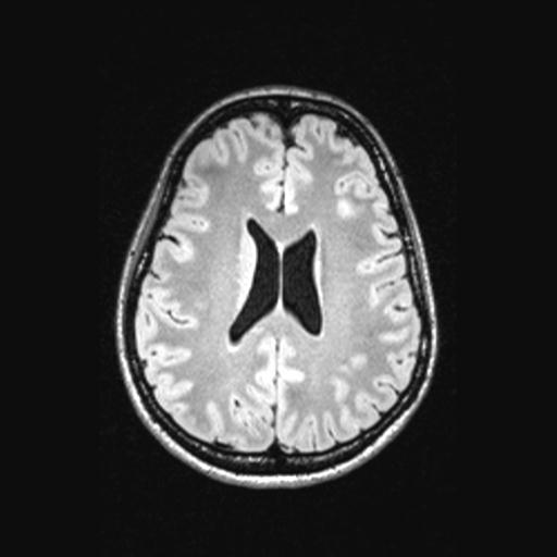 Atretic encephalocoele with inferior vermis hypoplasia (Radiopaedia 30443-31108 Axial 101).jpg