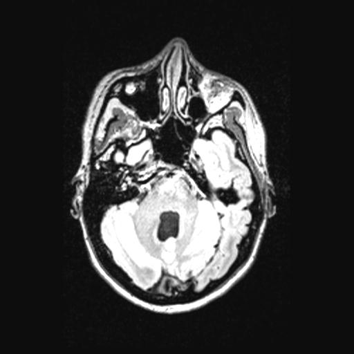 Atretic encephalocoele with inferior vermis hypoplasia (Radiopaedia 30443-31108 Axial 48).jpg