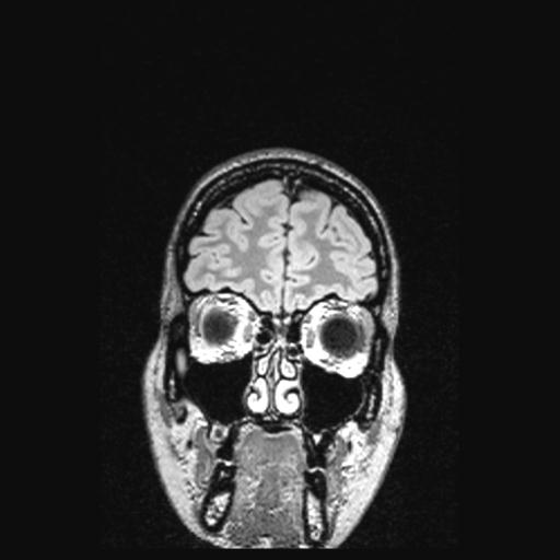 File:Atretic encephalocoele with inferior vermis hypoplasia (Radiopaedia 30443-31108 Coronal FLAIR 153).jpg