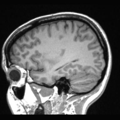 Atretic encephalocoele with inferior vermis hypoplasia (Radiopaedia 30443-31108 Sagittal T1 34).jpg