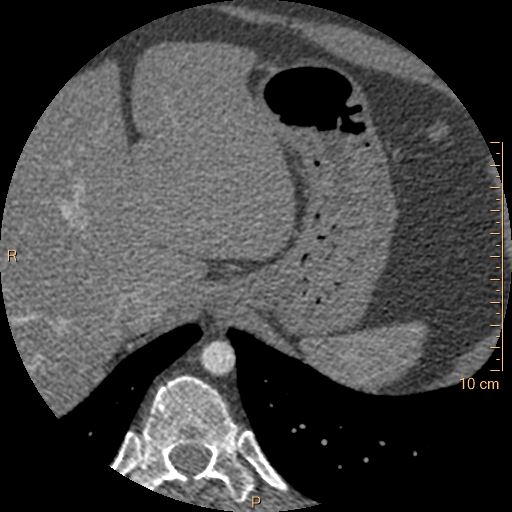 Atrial septal defect (upper sinus venosus type) with partial anomalous pulmonary venous return into superior vena cava (Radiopaedia 73228-83961 A 291).jpg