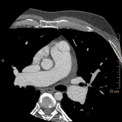 Atrial septal defect (upper sinus venosus type) with partial anomalous pulmonary venous return into superior vena cava (Radiopaedia 73228-83961 A 76).jpg