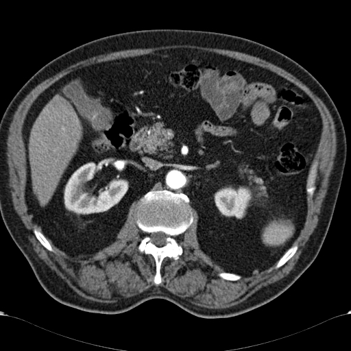 Atypical hepatocellular carcinoma (Radiopaedia 41744-44698 A 42).jpg