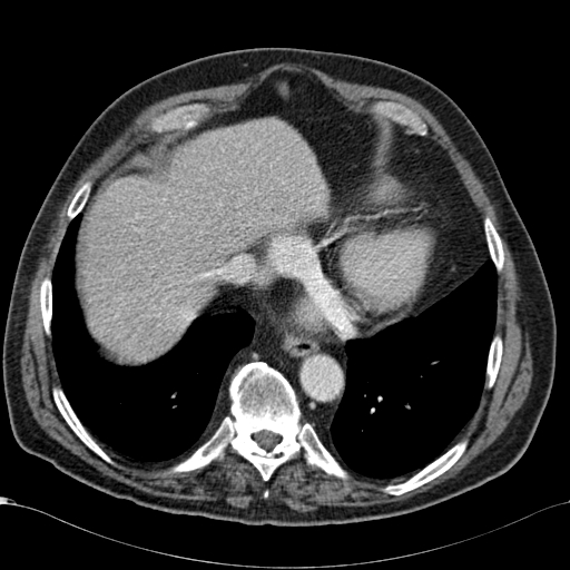 Atypical hepatocellular carcinoma (Radiopaedia 41744-44698 B 9).jpg